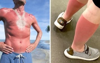 17 случаев, когда люди недооценили обжигающую силу солнца (19 фото)