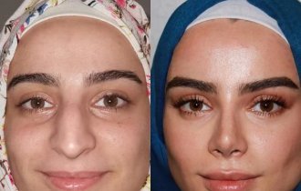“Miracles of plastic surgery”: incredible transformations of patients of plastic surgeons from Turkey (16 photos)