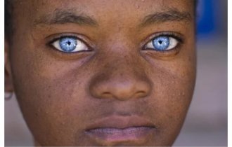 "Красивые глаза" как симптом болезни (12 фото)