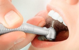 Как ставят пломбу на зуб (10 фото)
