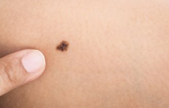 7 признаков рака кожи, на которые мало кто обращает внимания (8 фото)
