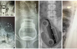 15 рентген снимков, демонстрирующих посторонние предметы внутри (16 фото)