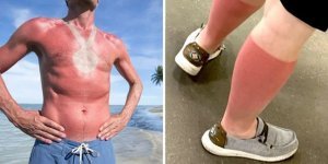 17 випадків, коли люди недооцінили обпалюючу силу сонця (19 фото)