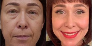 14 людей, которые решились на пластику - и вообще не пожалели (14 фото)